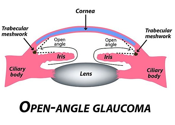 Types of Glaucoma