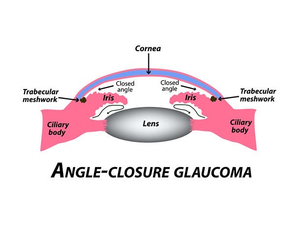Glaucoma Symptoms