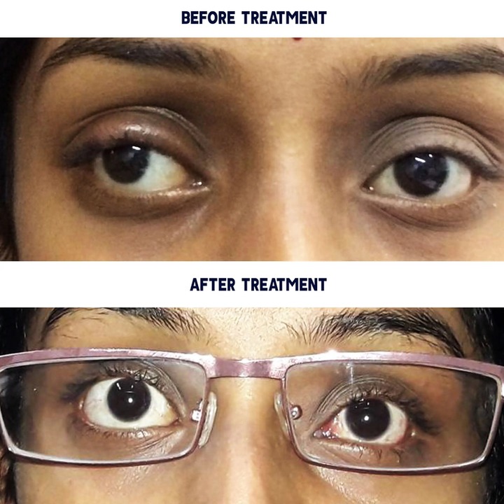 Surgical Treatment for Squint