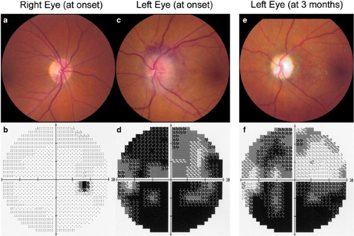 Ischemic Optic Neuropathy