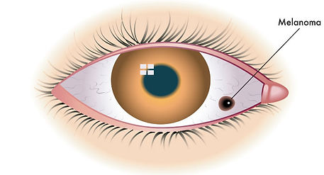 Ocular Melanoma