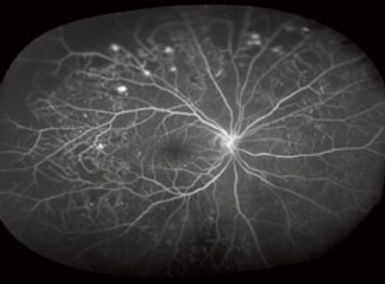 Retina